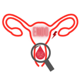 Endométriose : un appel à volontaires