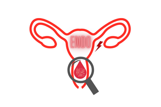 Endométriose : un appel à volontaires