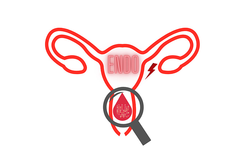 Endométriose : un appel à volontaires